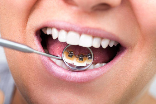estetica dentale e riallineamento denti firenze