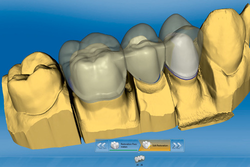 come si crea un dente digitale
