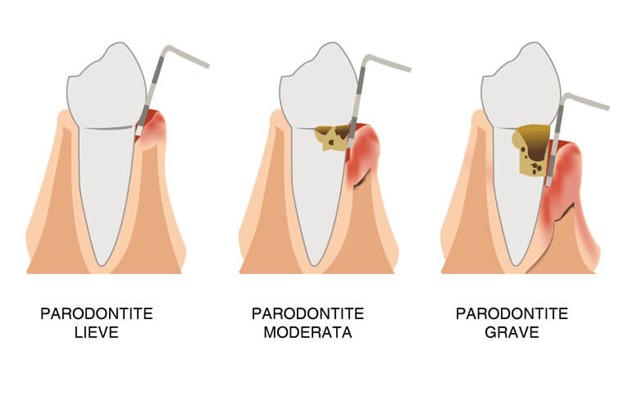 tipologie di parodontite