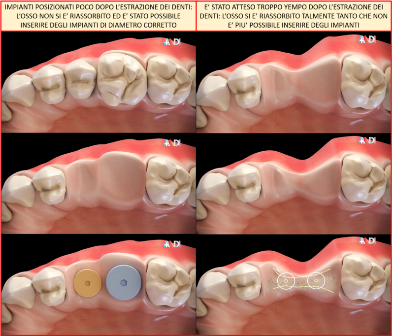 Implantologia dentale a Firenze